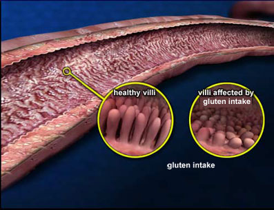 gluten intolerant intestines.